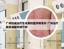 广州权威治疗牛皮癣的医院哪家好 广州治疗银屑病医院排行榜