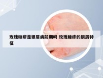 玫瑰糠疹是银屑病前期吗 玫瑰糠疹的银屑特征