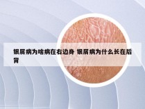 银屑病为啥病在右边身 银屑病为什么长在后背