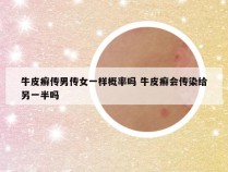 牛皮癣传男传女一样概率吗 牛皮癣会传染给另一半吗