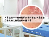 石家庄治疗牛皮癣比较厉害的中医 石家庄治疗牛皮癣比较厉害的中医专家