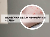 初起头部发银屑病怎么样 头部银屑病的初期症状是什么