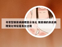 寻常型银屑病病理显示角化 银屑病的表皮病理变化特征是角化过度