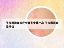 牛皮癣激光治疗全身多少钱一次 牛皮癣激光治疗仪