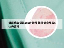 银屑病会引起scc升高吗 银屑病会导致scc升高吗