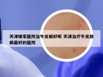 天津哪家医院治牛皮癣好呢 天津治疗牛皮肤癣最好的医院