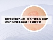 银屑病能治好吗皮肤不能吃什么水果 银屑病能治好吗皮肤不能吃什么水果和蔬菜