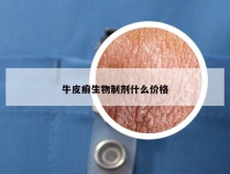 牛皮癣生物制剂什么价格