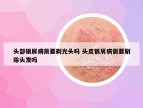 头部银屑病需要剃光头吗 头皮银屑病需要剔除头发吗