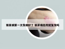 银屑病第一次发病好了 银屑病出院就复发吗
