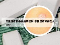 干性湿疹和牛皮癣的区别 干性湿疹和癣怎么区分