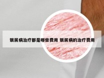 银屑病治疗都是哪些费用 银屑病的治疗费用