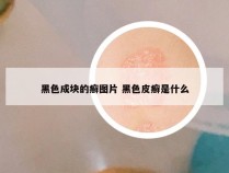 黑色成块的癣图片 黑色皮癣是什么