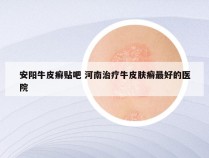 安阳牛皮癣贴吧 河南治疗牛皮肤癣最好的医院