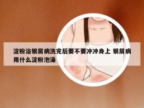 淀粉浴银屑病洗完后要不要冲冲身上 银屑病用什么淀粉泡澡