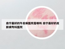 南宁最好的牛皮癣医院是哪所 南宁最好的皮肤病专科医院