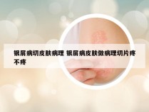 银屑病切皮肤病理 银屑病皮肤做病理切片疼不疼