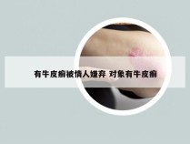 有牛皮癣被情人嫌弃 对象有牛皮癣