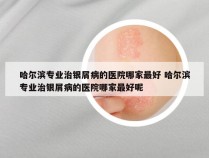 哈尔滨专业治银屑病的医院哪家最好 哈尔滨专业治银屑病的医院哪家最好呢