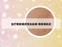 治疗银屑病诱发白血病 银屑病白庀