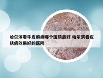 哈尔滨看牛皮癣病哪个医院最好 哈尔滨看皮肤病效果好的医院