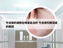 牛皮癣的病根在哪里能治好 牛皮癣归根结底的原因