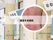 国龙牛皮癣网