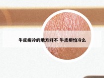 牛皮癣冷的地方好不 牛皮癣怕冷么