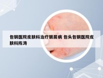 包钢医院皮肤科治疗银屑病 包头包钢医院皮肤科陈涛