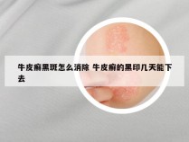 牛皮癣黑斑怎么消除 牛皮癣的黑印几天能下去