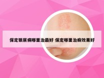 保定银屑病哪里治最好 保定哪里治癣效果好