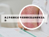 身上牛皮癣红点 牛皮肤癣红色全身都有怎么办