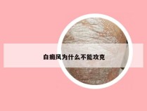 白癜风为什么不能攻克