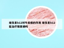 维生素b12对牛皮癣的作用 维生素b12能治疗银屑病吗
