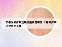 长春治银屑病正规的医院在哪里 长春银屑病研究所怎么样