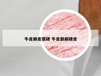 牛皮癣皮很硬 牛皮肤癣硬皮