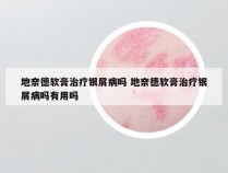地奈德软膏治疗银屑病吗 地奈德软膏治疗银屑病吗有用吗