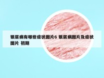 银屑病有哪些症状图片6 银屑病图片及症状图片 初期
