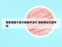 银屑病是不是手脚指甲会烂 银屑病会烂指甲吗