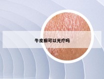 牛皮癣可以光疗吗