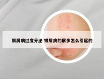 银屑病过度分泌 银屑病的屑多怎么引起的