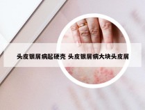 头皮银屑病起硬壳 头皮银屑病大块头皮屑