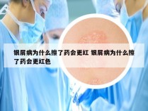 银屑病为什么擦了药会更红 银屑病为什么擦了药会更红色