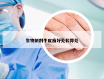 生物制剂牛皮癣好处和弊处