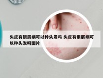 头皮有银屑病可以种头发吗 头皮有银屑病可以种头发吗图片