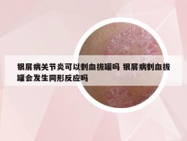 银屑病关节炎可以刺血拔罐吗 银屑病刺血拔罐会发生同形反应吗