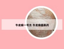 牛皮癣一号方 牛皮癣最新药