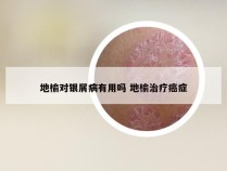 地榆对银屑病有用吗 地榆治疗癌症