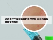 辽源治疗牛皮癣最好的医院地址 辽源市看皮肤哪家医院好