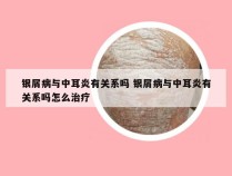 银屑病与中耳炎有关系吗 银屑病与中耳炎有关系吗怎么治疗
